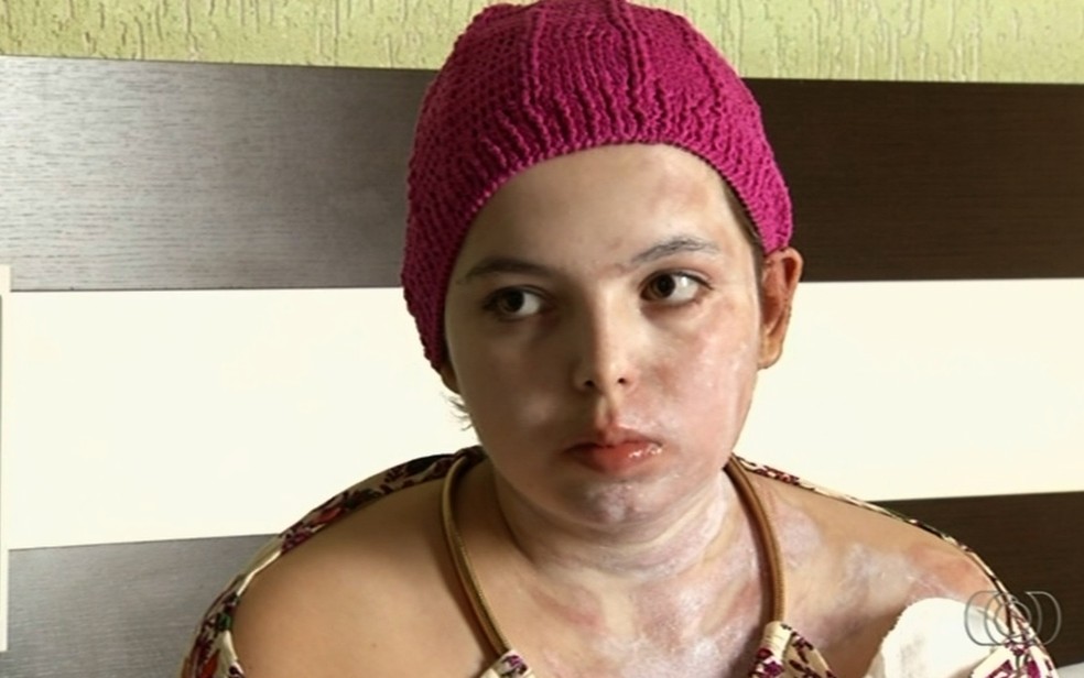 Estudante Beatriz Carneiro de Araújo, de 20 anos, que foi queimada por desconhecida em São Luís de Montes Belos Goiás (Foto: Reprodução/TV Anhanguera)