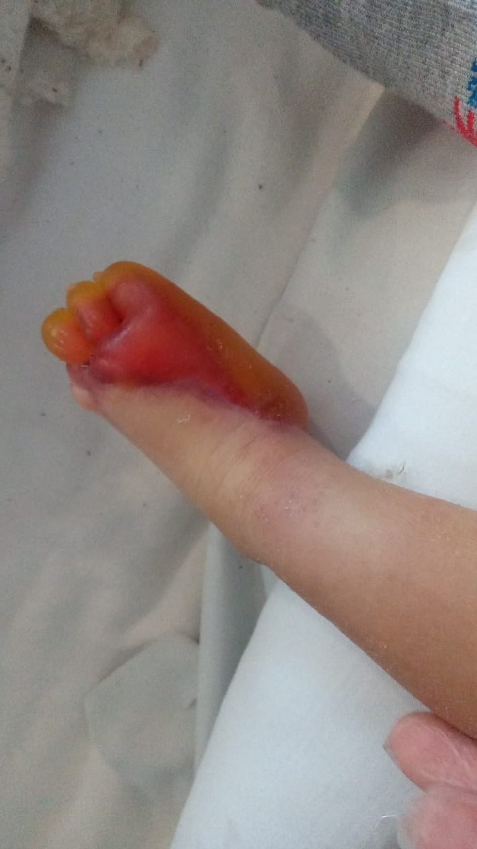Bebê sofre queimadura nos pés após hospital esquecer aquecedor ligado em Jacareí; família acusa hospital de negligência. — Foto: Arquivo pessoal