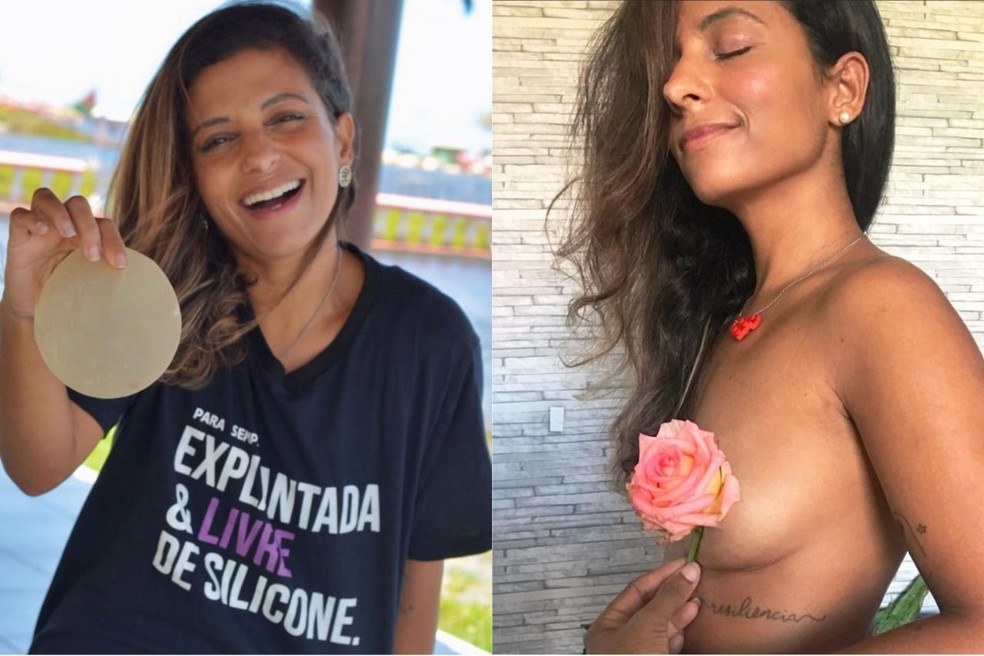 Larissa de Almeida tem um perfil nas redes sociais onde compartilha informações sobre explante. — Foto: Arquivo pessoal