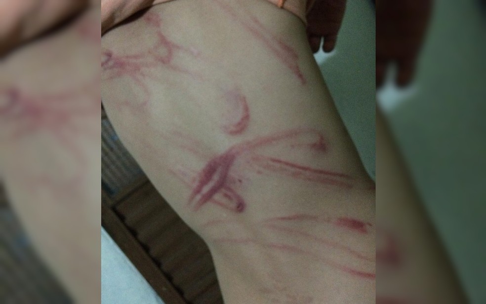 Menino de 9 anos que foi espancado teve marcas nas costas; pai foi preso e confessou — Foto: Reprodução/TV Anhanguera