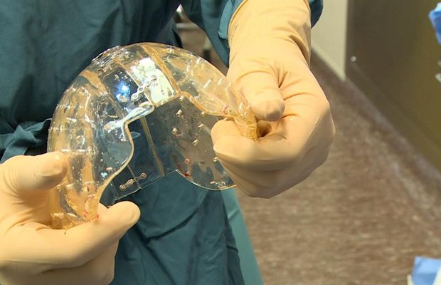 Médico mostra estrutura que substituiu o crânio - feita de plástico e com impressora 3D (Foto: EFE)
