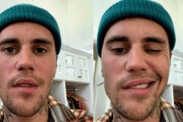 O cantor Justin Bieber foi diagnosticado com a síndrome de Ramsay Hunt, que paralisou metade de seu rosto.  O cantor Justin Bieber foi diagnosticado com a síndrome de Ramsay Hunt, que paralisou metade de seu rosto (Foto: Reprodução/Instagram)