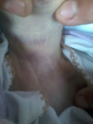 Pescoço de beb~e chegou a ficar machucado por conta de máscara improvisada (Foto: Arquivo Pessoal)